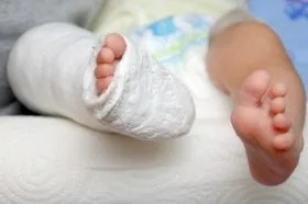 Broken leg